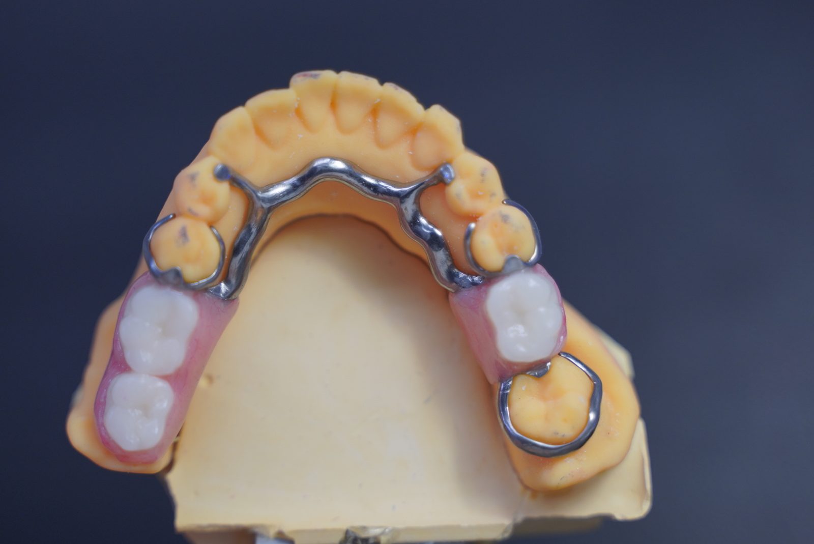 Removable partial denture with cast metal framework seated on a working model
