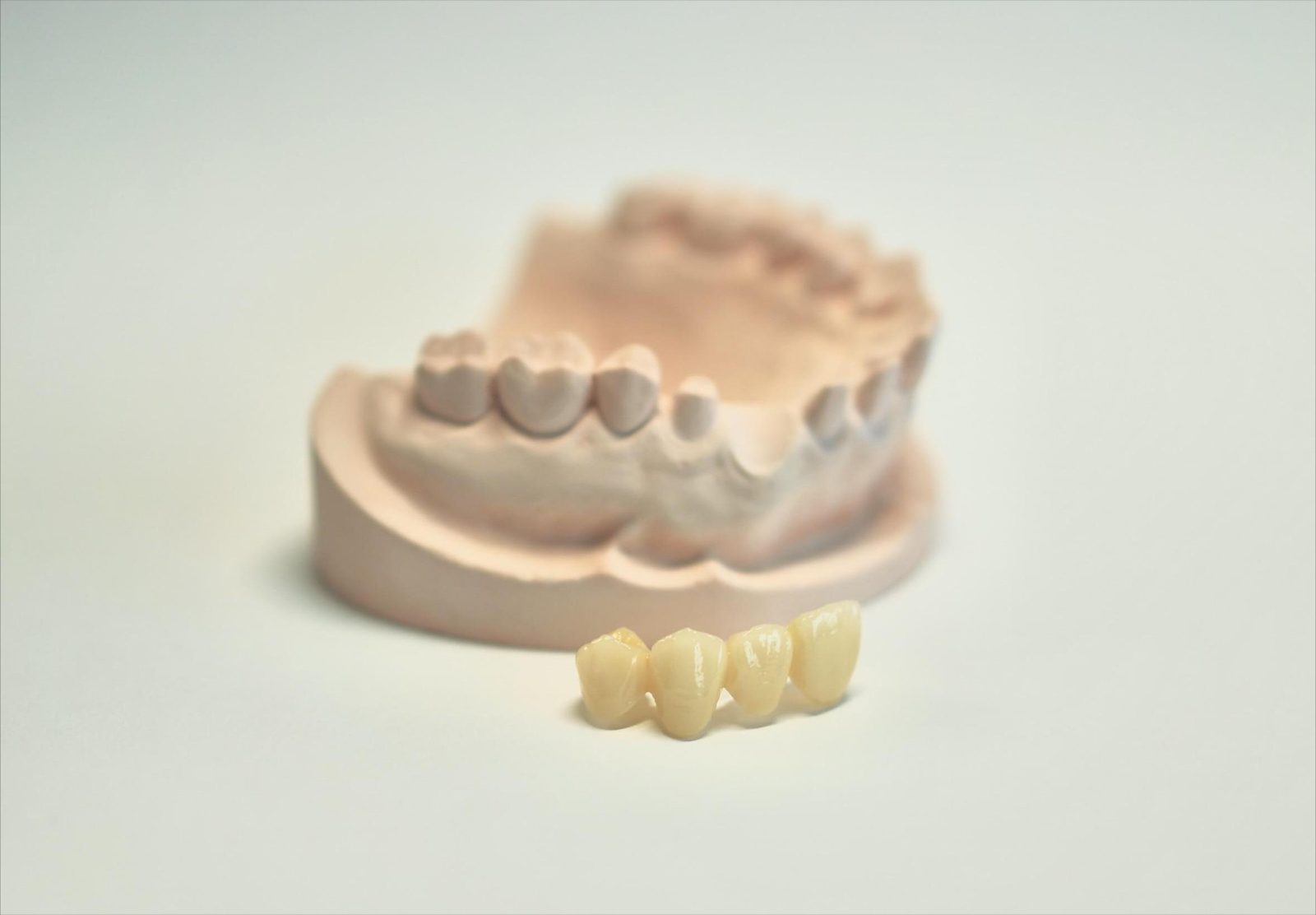 Four-unit zirconia bridge in front of the working model